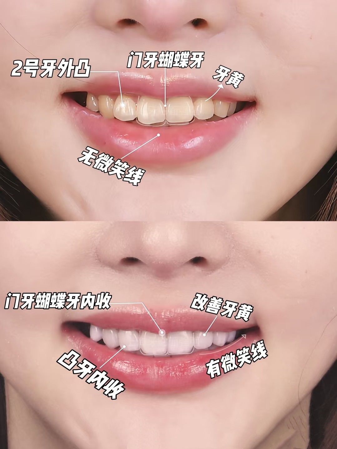 从&ldquo;蝴蝶牙&rdquo;到微笑杀！整牙堪比换头术！🦋