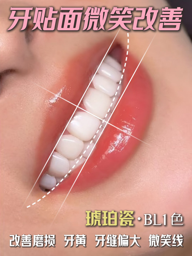 众说纷纭的牙贴面材料，哪个是你的心头爱！