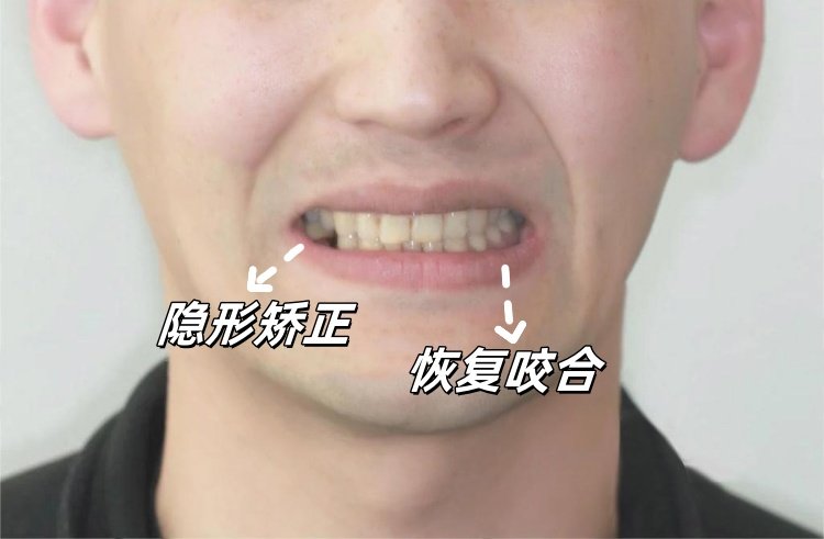 28岁地包天男孩自救指南｜隐形矫正让我从自卑到被夸"换头"