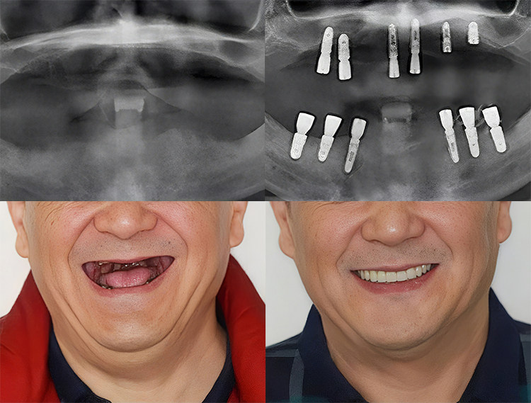 🦷陪父亲种牙全记录｜从抗拒到真香，这个决定我们做对了！案例图片 6
