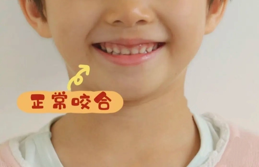 ❤️今日份小可爱牙套毕业啦！撒花庆祝～🎉