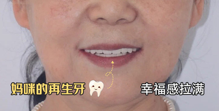 妈妈重获&ldquo;第三副牙齿&rdquo;！种植牙真实经历分享