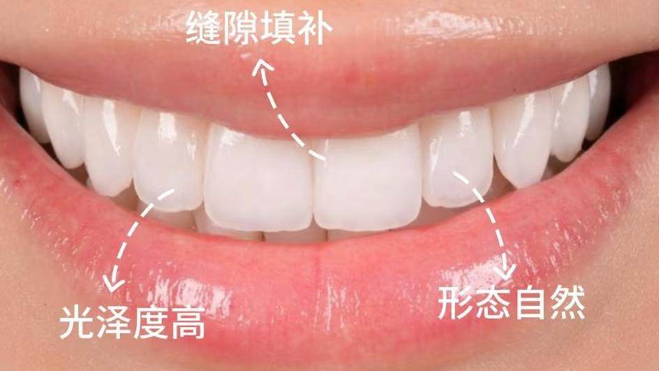 牙齿缝隙填补神器！让瑕疵秒变高级感✨