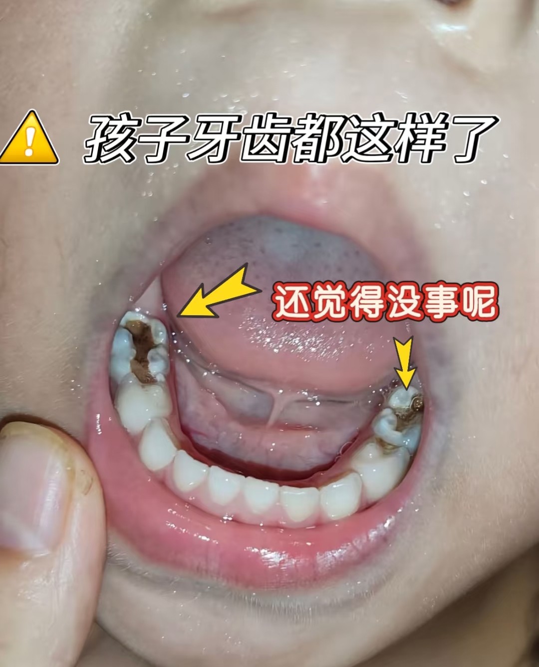 震惊！娃的牙烂成这样还说没事？😱心大的家长快醒醒！