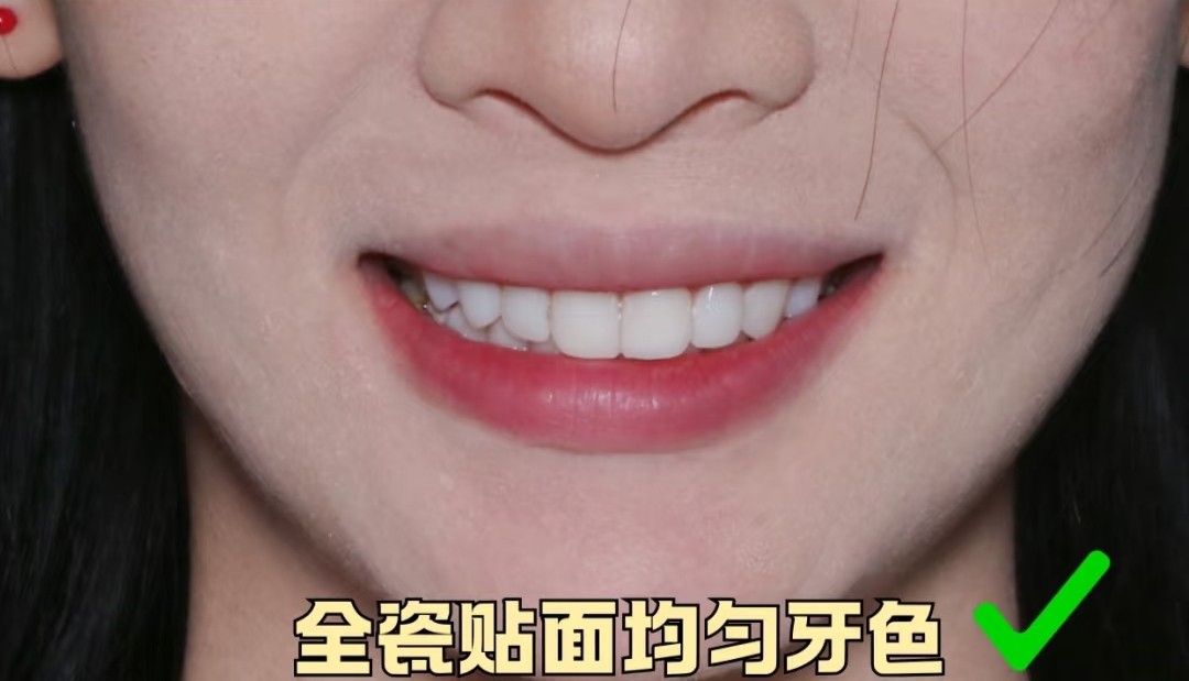 谁懂啊！牙齿大片白斑+黄斑，我的氟斑牙自救心得🦷✨案例图片 3