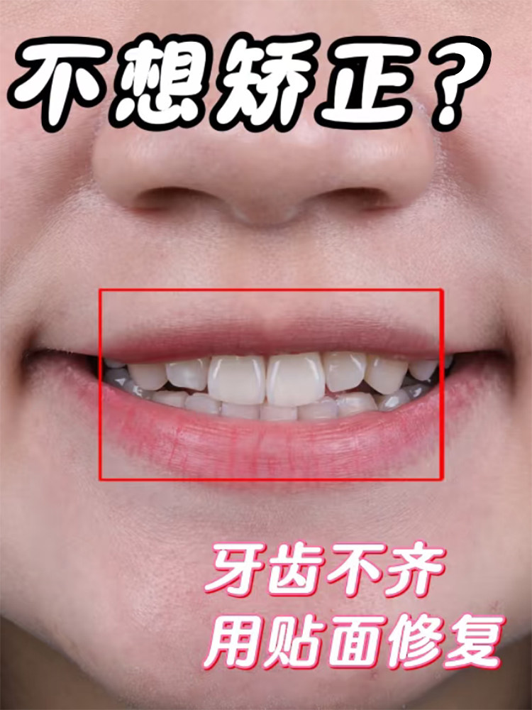 牙齿歪歪扭扭不整齐，不想矫正，也能还原！案例图片 1