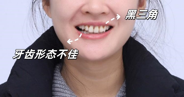 26岁牙套女孩的黑三角自救记｜从&ldquo;漏风笑&rdquo;到&ldquo;妈生感笑线&rdquo;的逆袭全记录案例图片 2
