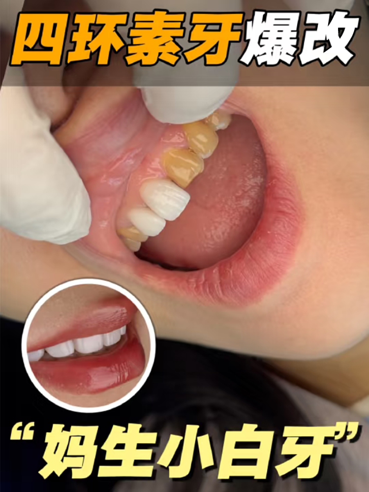 四环素牙的救赎来了！现在笑到脸酸