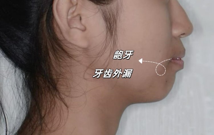 龅牙女孩的自救全记录｜从自卑到自信的2年正畸之旅案例图片 2