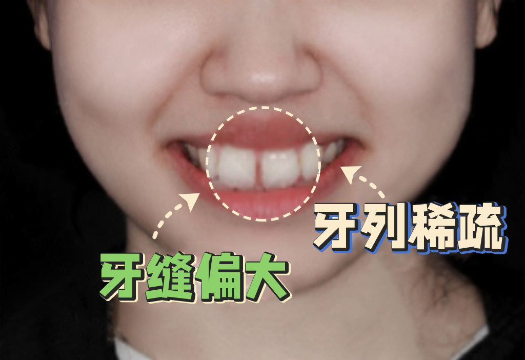 整牙逆袭！牙缝大妹子的3年矫正心得分享✨