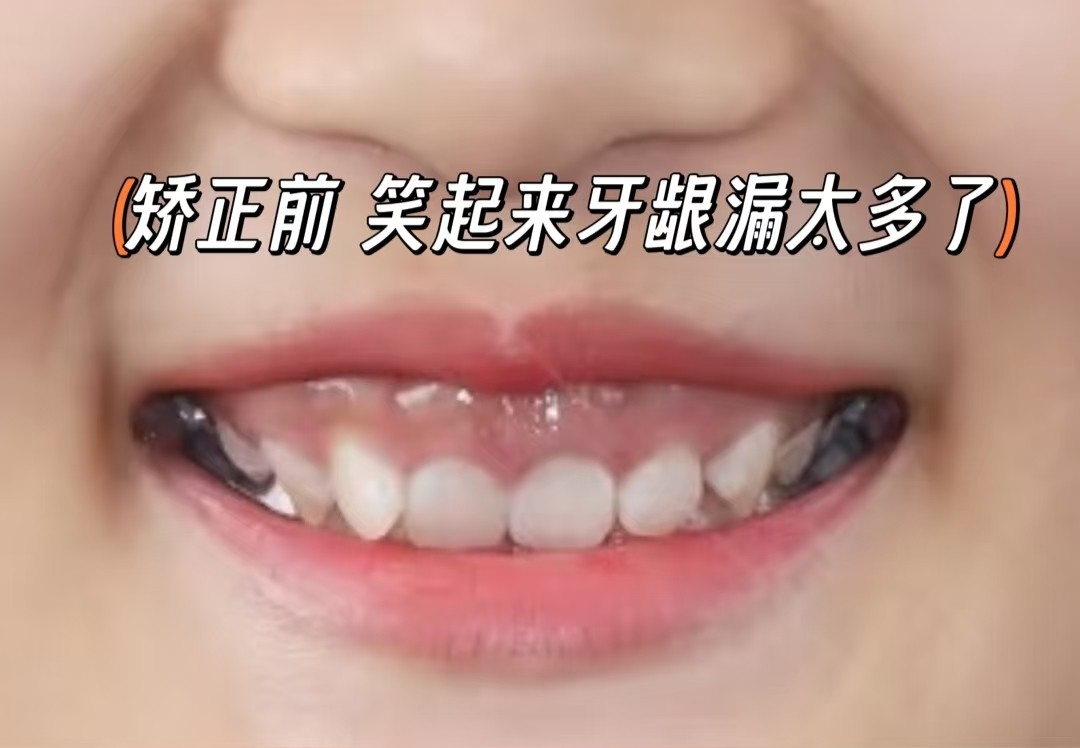 告别尴尬笑！我的牙齿矫正拯救计划✨