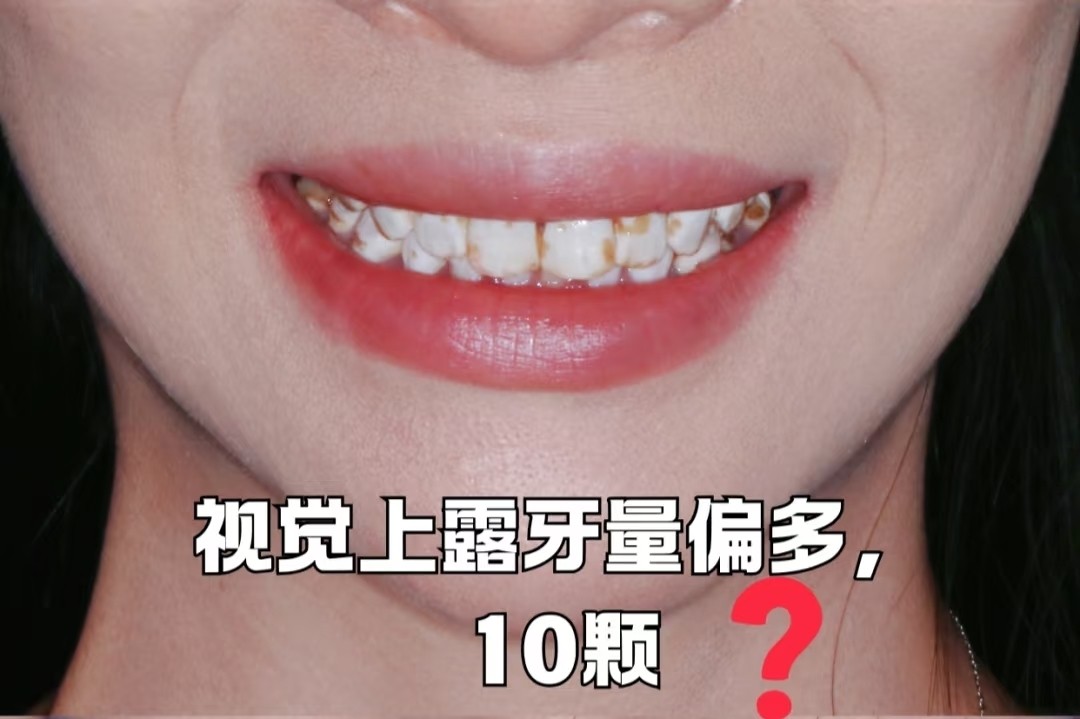 谁懂啊！牙齿大片白斑+黄斑，我的氟斑牙自救心得🦷✨案例图片 4