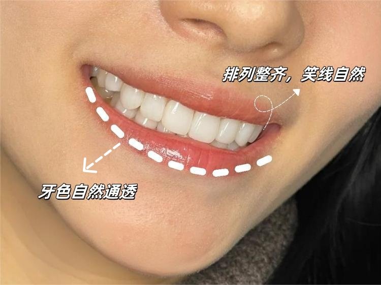 明星同款笑容逆袭密码｜普通女孩如何靠牙贴面颜值开挂⁉️案例图片 1