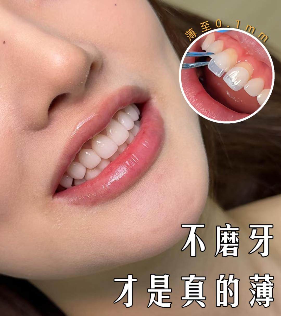 💡超详细！微抛免磨牙贴面真实体验分享案例图片 1