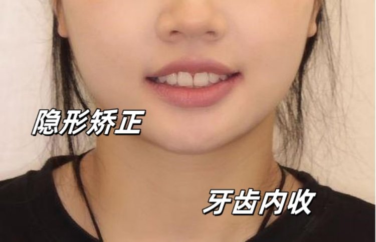 💫23岁龅牙女孩隐形矫正全记录｜从"凸嘴妹"到"侧颜杀"的逆袭之路