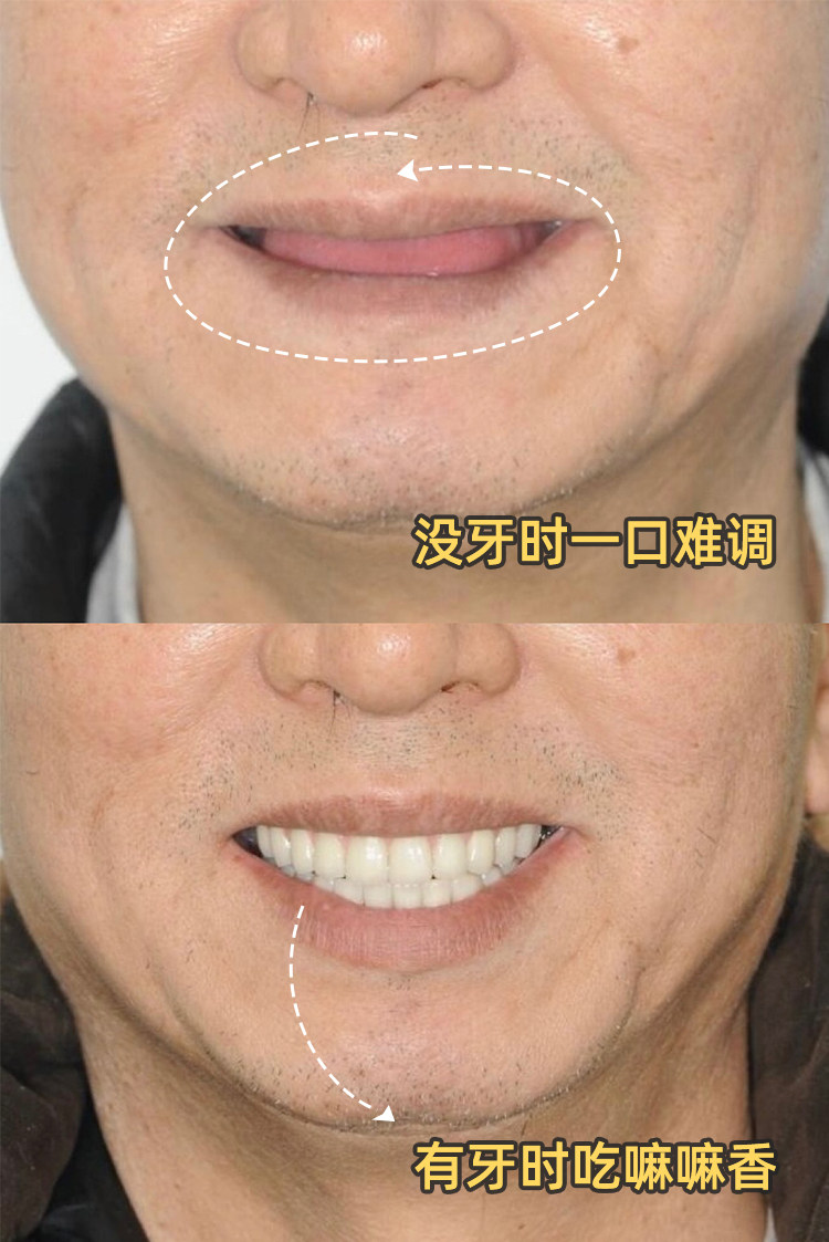 ⚠️爷爷种牙记｜缺牙老人必看！