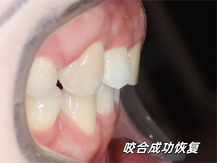 🦷26岁戴牙套被说&ldquo;没必要&rdquo;，现在她们都问我怎么做到的案例图片 4