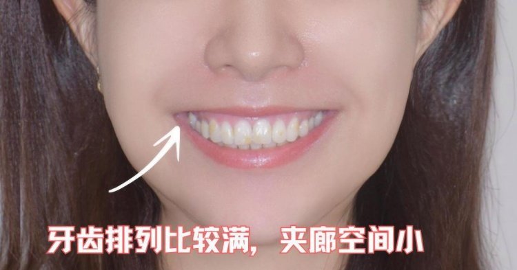 ✨32岁逆袭记：美学贴面+微笑线，我的笑容重生之路！案例图片 2
