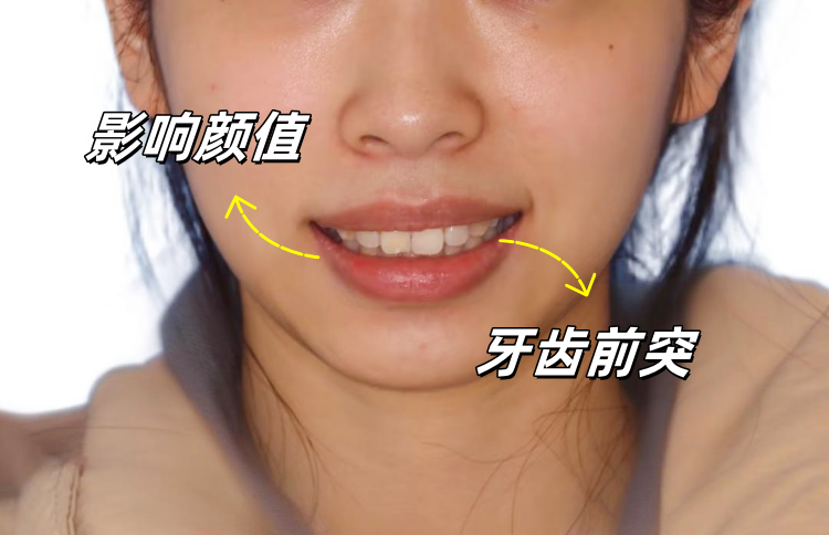 从"钢牙妹"到"隐形美人"｜我的5.8万舌侧矫正血泪史案例图片 2