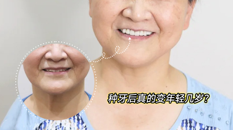 🌱种牙后我竟被误认成女儿姐姐！50岁逆龄秘密大公开✨