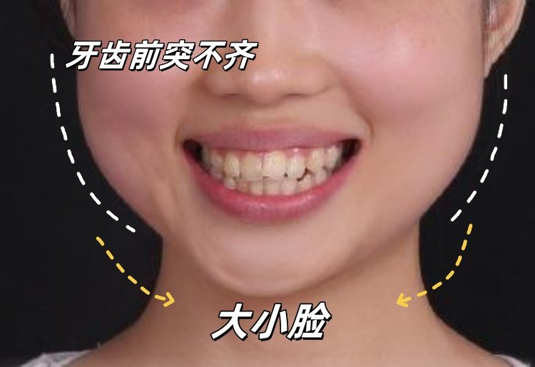 🦷牙套毕业典礼！嘴凸女孩的逆袭日记案例图片 4