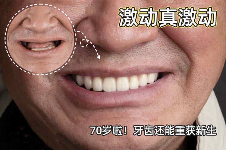 📝【70岁爷爷全口种植牙真实记录】从"假牙总掉"到"啃苹果自由"的逆袭故事案例图片 1