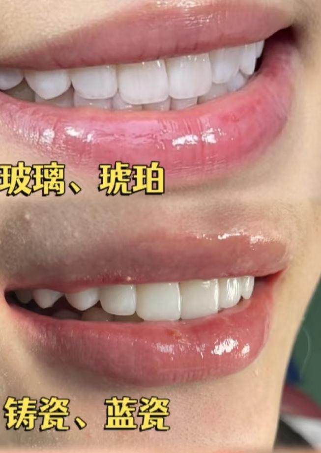 牙贴面材质怎么选？🌟案例图片 2
