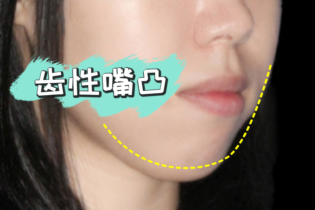 凸嘴矫正2年对比｜真实经验+避坑指南✨