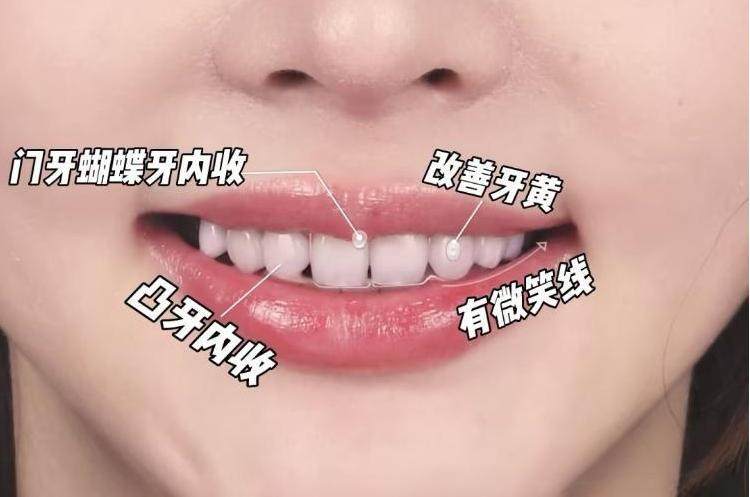 🌟牙黄自卑20年｜1次贴片让我笑出女团感！明星同款微笑攻略🌟