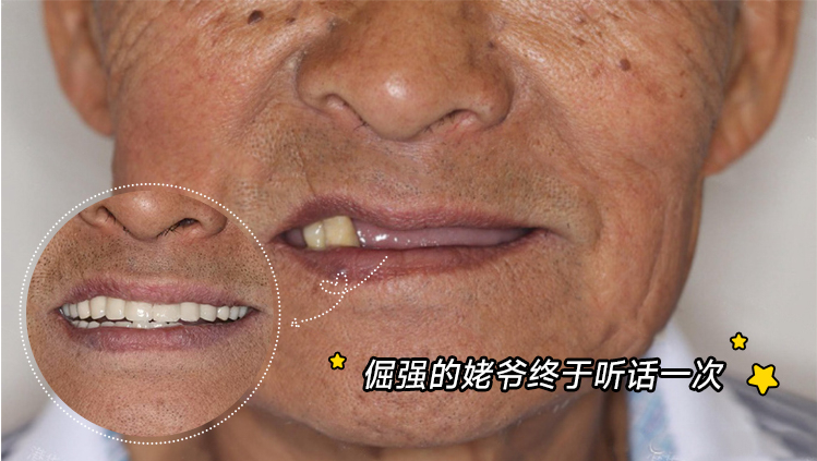 68岁倔老头含泪种牙记：谁说老人不能重获新牙？