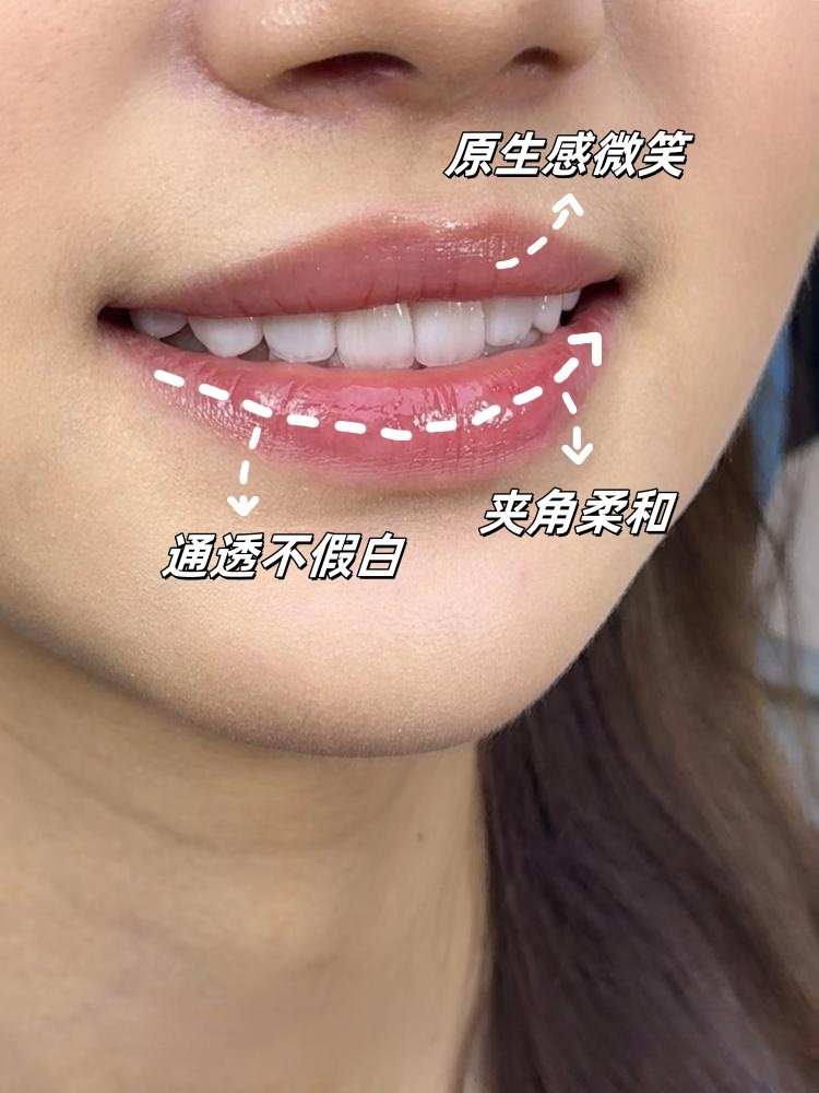 💎我的牙贴面逆袭记｜从"牙黄妹"到"微笑女神"的蜕变全记录