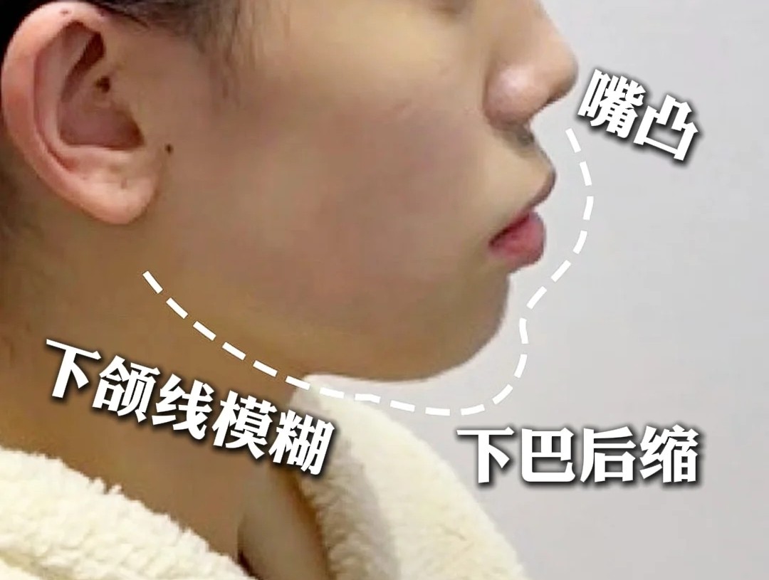 凸嘴+下巴后缩，30分钟逆袭绝美侧颜