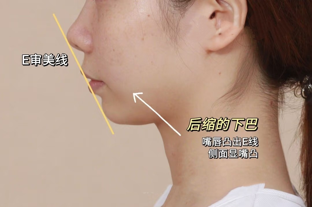侧颜杀手？NO！嘴凸+后缩下巴自救指南💡案例图片 2