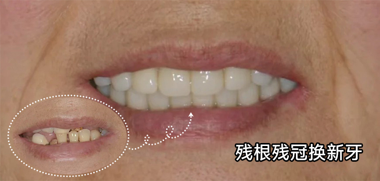 奶奶的牙齿重生记！从残根到新牙，她笑了整整一年！