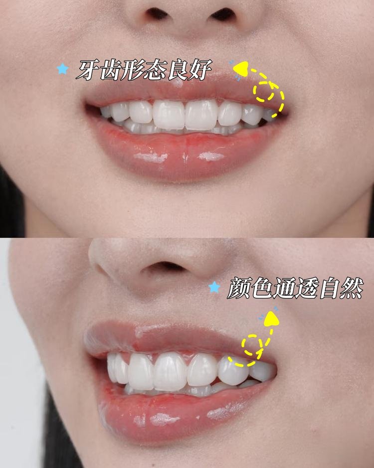 牙贴面逆袭记｜普通女孩如何靠细节美出圈！
