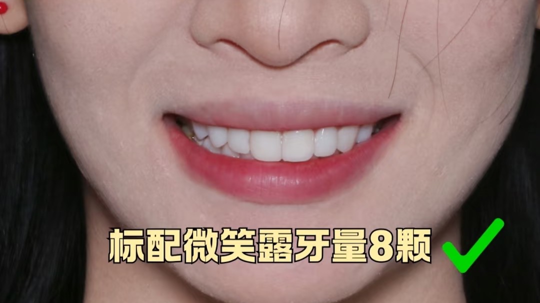 谁懂啊！牙齿大片白斑+黄斑，我的氟斑牙自救心得🦷✨案例图片 2