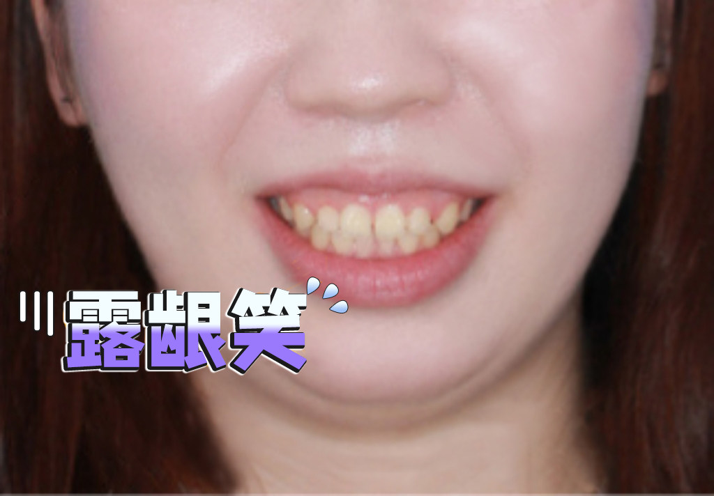 😆露龈笑逆袭记｜从&ldquo;牙龈仙子&rdquo;到自信笑花的3个小秘密✨