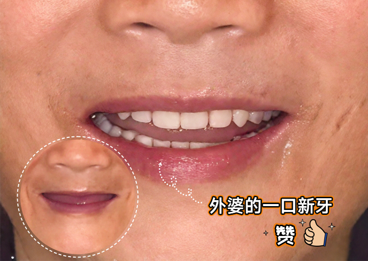 67岁外婆的"第三副牙齿"重生记