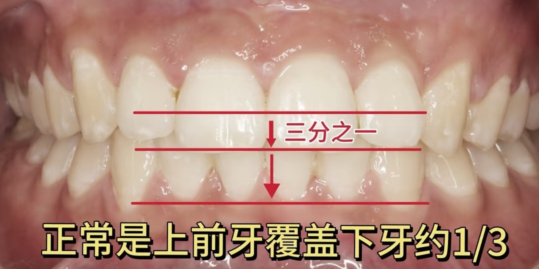 重度深覆合自救指南！看不到下牙也能逆袭微笑线！ ✨