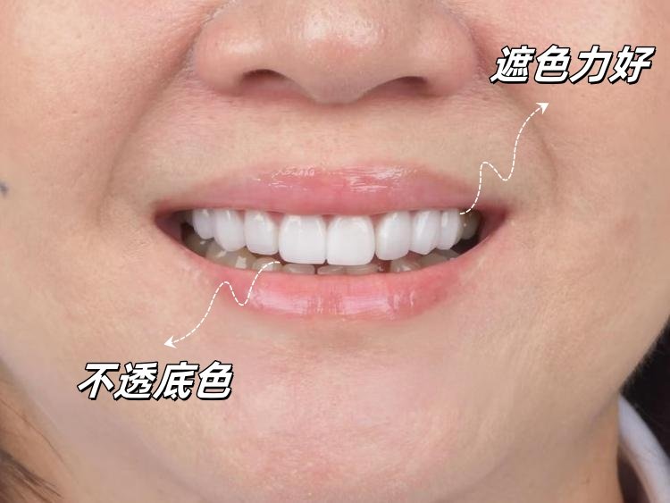 牙齿贴面全记录｜黄牙+歪牙逆袭"笑容自由"的变美指南案例图片 1