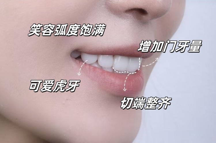 从"尴尬笑"到"钻石笑"！我的美学贴面逆袭日记案例图片 4