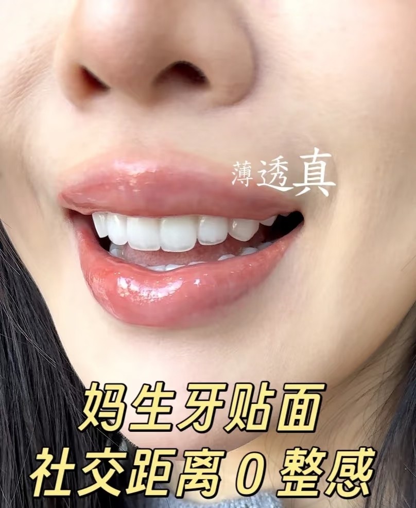 💎【妈生牙贴面实测】牙齿秒变&ldquo;玻璃瓷&rdquo;，素颜也能美到发光！💎✨案例图片 1