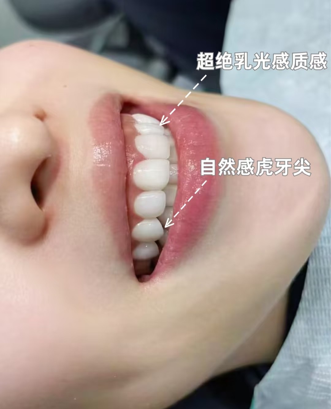 虎牙尖的天然萌感，被闺蜜追着问的牙齿小心机！👏案例图片 1