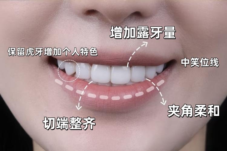从"尴尬笑"到"钻石笑"！我的美学贴面逆袭日记案例图片 1