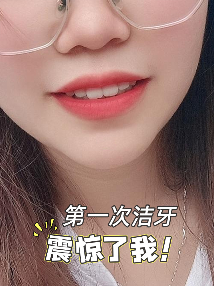 💫宝藏洁牙体验｜人均￥50+get白领同款笑容！
