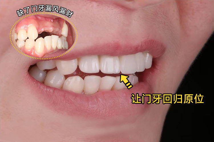 ✨缺了门牙漏风漏财？我的门牙终于归位啦！案例图片 1