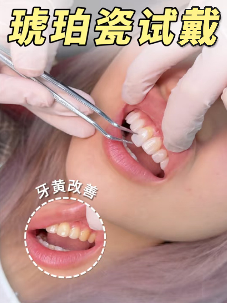 真没想到牙齿美学修复真能拥有明星般的靓白牙齿！案例图片 1