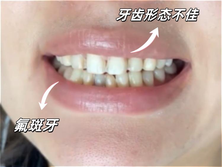 明星同款笑容逆袭密码｜普通女孩如何靠牙贴面颜值开挂⁉️案例图片 2