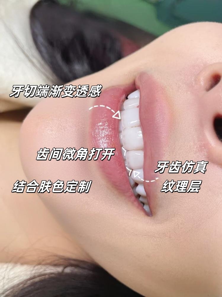 🌟28岁金融女的牙齿重生记｜从自卑到自信只需要这颗"兔牙"🌟