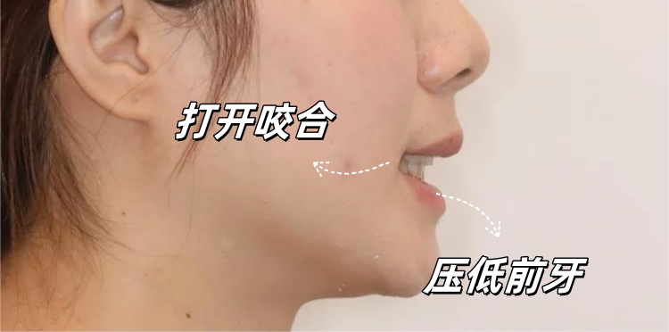 🦷26岁戴牙套被说&ldquo;没必要&rdquo;，现在她们都问我怎么做到的